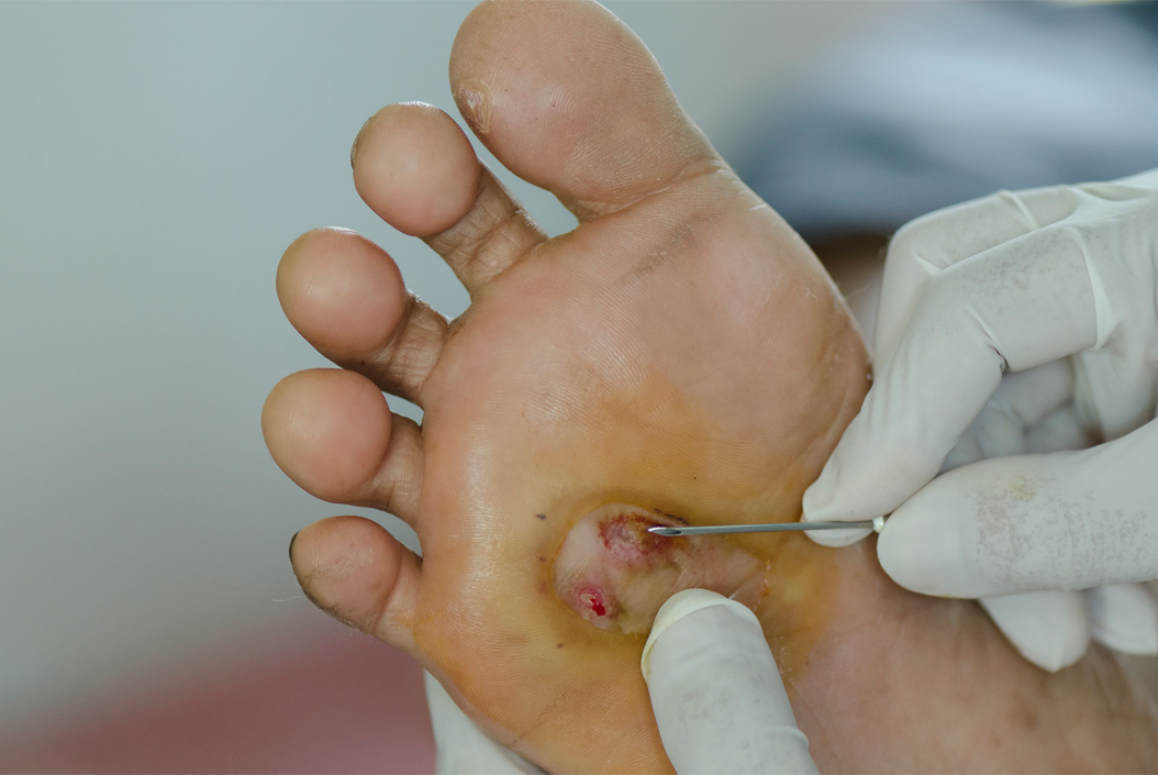 Diabetes Foot Care - Image of a foot ulcer that has not healed because of Diabetes